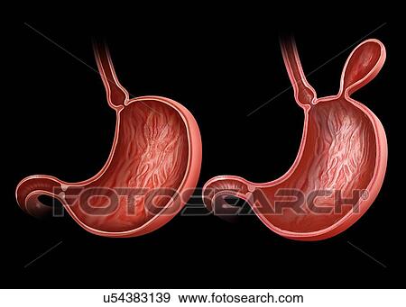 Stock Illustration - Cross section the human stomach with and without a hernia, computer artwork.. Fotosearch