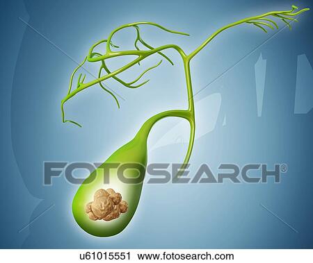 Clip Art - Human gall bladder with gall stones, computer illustration.. Fotosearch