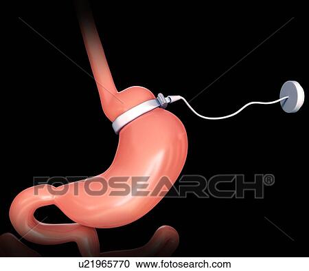 Clipart - Human gastric band, computer artwork.. Fotosearch