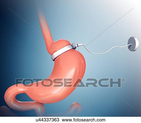 Human gastric band, computer artwork. View Large Illustration Drawing - Human gastric band, computer artwork.. Fotosearch