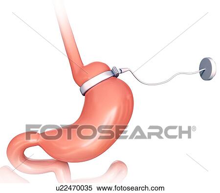 Stock Illustration - Human gastric band, computer artwork.. Fotosearch