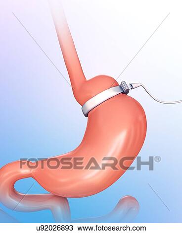 Drawing - Human gastric band, computer illustration.. Fotosearch