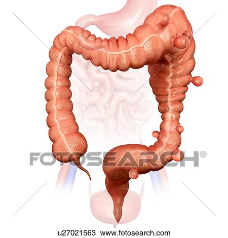 Human large intestine showing a megacolon and diverticulitis, computer illustration. View Large Illustration Drawing - Human large intestine showing a megacolon and diverticulitis, computer illustration.. Fotosearch