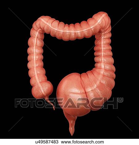 Drawing - Human large intestine showing a megacolon, computer illustration.. Fotosearch