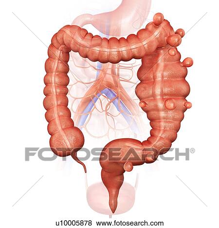 Human large intestine showing a megacolon and diverticulitis, computer artwork. View Large Illustration Stock Illustration - Human large intestine showing a megacolon and diverticulitis, computer artwork.. Fotosearch