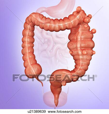 Stock Illustration - Human large intestine showing a megacolon and diverticulitis, computer artwork.. Fotosearch
