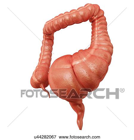 Stock Illustration - Human large intestine showing a megacolon, computer artwork.. Fotosearch