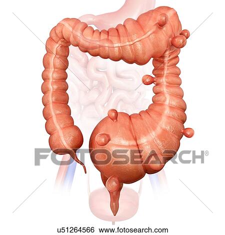 Human large intestine showing a megacolon and diverticulitis, computer artwork. View Large Illustration Stock Illustration - Human large intestine showing a megacolon and diverticulitis, computer artwork.. Fotosearch