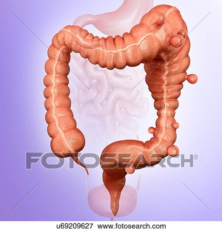 Human large intestine showing a megacolon and diverticulitis, computer illustration. View Large Illustration Stock Illustration - Human large intestine showing a megacolon and diverticulitis, computer illustration.. Fotosearch