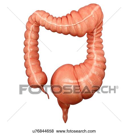 Stock Illustration - Human large intestine showing a megacolon, computer artwork.. Fotosearch
