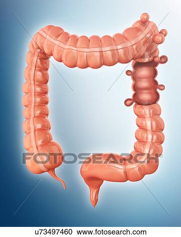 Human large intestine showing diverticulitis, computer illustration. View Large Illustration Clipart - Human large intestine showing diverticulitis, computer illustration.. Fotosearch
