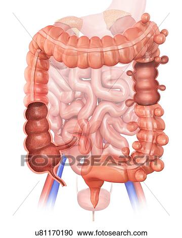 Human large intestine showing diverticulitis, computer illustration. View Large Illustration Clipart - Human large intestine showing diverticulitis, computer illustration.. Fotosearch