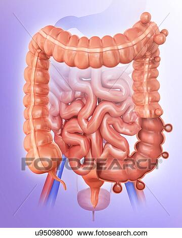 Human large intestine showing diverticulitis, computer artwork. View Large Illustration Clipart - Human large intestine showing diverticulitis, computer artwork.. Fotosearch