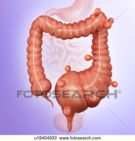 Drawing - Human large intestine showing diverticulitis, computer illustration.. Fotosearch