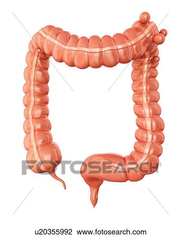 Drawing - Human large intestine showing diverticulitis, computer artwork.. Fotosearch