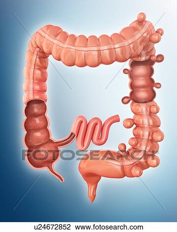 Human large intestine showing diverticulitis, computer artwork. View Large Illustration Drawing - Human large intestine showing diverticulitis, computer artwork.. Fotosearch