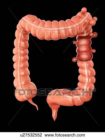 Drawing - Human large intestine showing diverticulitis, computer illustration.. Fotosearch
