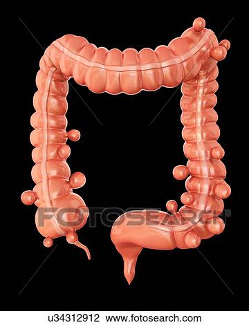 Human large intestine showing diverticulitis, computer artwork. View Large Illustration Drawing - Human large intestine showing diverticulitis, computer artwork.. Fotosearch