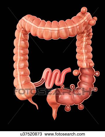Human large intestine showing diverticulitis, computer illustration. View Large Illustration Drawing - Human large intestine showing diverticulitis, computer illustration.. Fotosearch