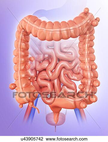 Drawing - Human large intestine showing diverticulitis, computer artwork.. Fotosearch