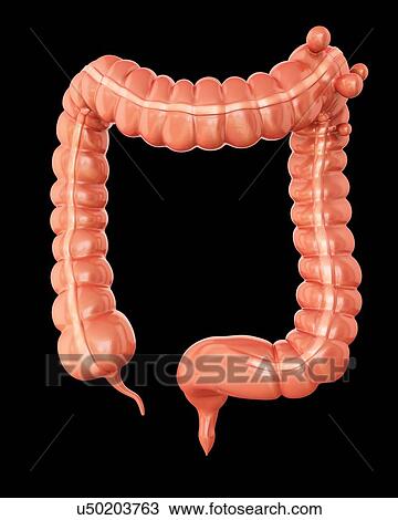 Drawing - Human large intestine showing diverticulitis, computer illustration.. Fotosearch