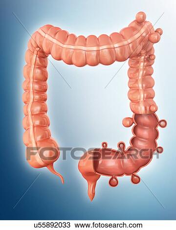 Human large intestine showing diverticulitis, computer illustration. View Large Illustration Drawing - Human large intestine showing diverticulitis, computer illustration.. Fotosearch