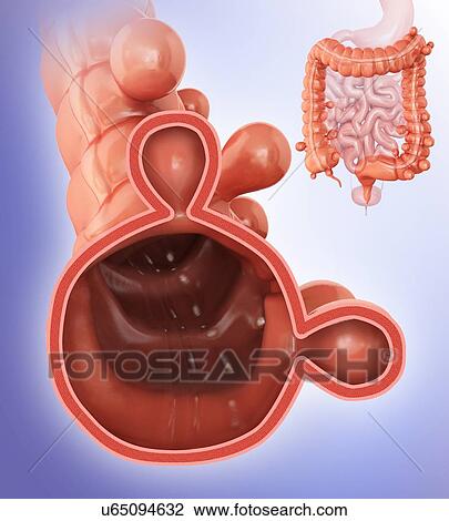 Human large intestine showing diverticulitis, computer artwork. View Large Illustration Drawing - Human large intestine showing diverticulitis, computer artwork.. Fotosearch