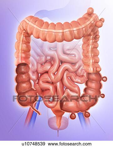 Human large intestine showing diverticulitis, computer artwork. View Large Illustration Stock Illustration - Human large intestine showing diverticulitis, computer artwork.. Fotosearch