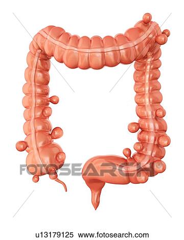 Human large intestine showing diverticulitis, computer artwork. View Large Illustration Stock Illustration - Human large intestine showing diverticulitis, computer artwork.. Fotosearch