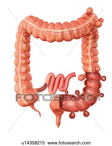 Human large intestine showing diverticulitis, computer artwork. View Large Illustration Stock Illustration - Human large intestine showing diverticulitis, computer artwork.. Fotosearch