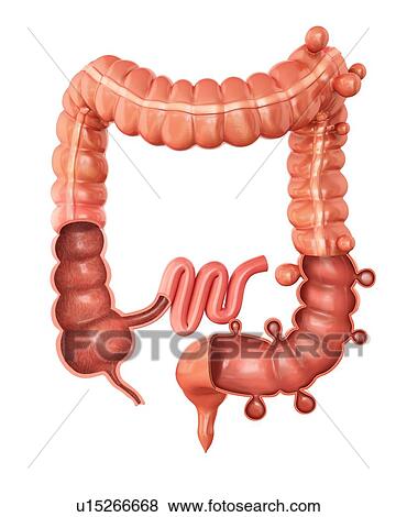 Human large intestine showing diverticulitis, computer artwork. View Large Illustration Stock Illustration - Human large intestine showing diverticulitis, computer artwork.. Fotosearch