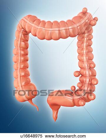 Stock Illustration - Human large intestine showing diverticulitis, computer artwork.. Fotosearch