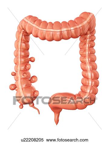 Human large intestine showing diverticulitis, computer illustration. View Large Illustration Stock Illustration - Human large intestine showing diverticulitis, computer illustration.. Fotosearch