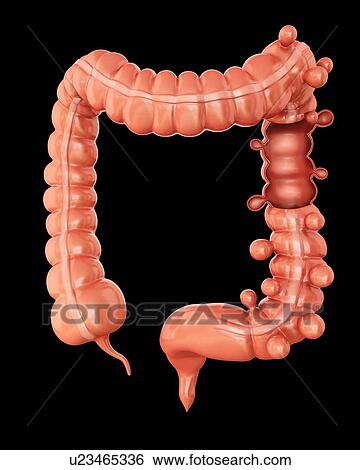 Human large intestine showing diverticulitis, computer artwork. View Large Illustration Stock Illustration - Human large intestine showing diverticulitis, computer artwork.. Fotosearch