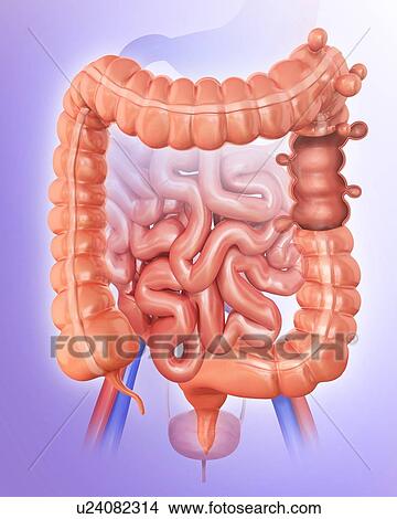Stock Illustration - Human large intestine showing diverticulitis, computer artwork.. Fotosearch