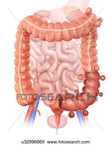 Human large intestine showing diverticulitis, computer illustration. View Large Illustration Stock Illustration - Human large intestine showing diverticulitis, computer illustration.. Fotosearch