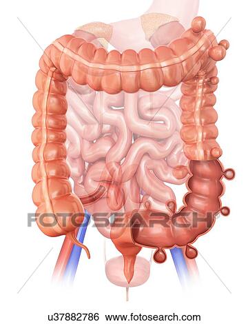 Human large intestine showing diverticulitis, computer artwork. View Large Illustration Stock Illustration - Human large intestine showing diverticulitis, computer artwork.. Fotosearch
