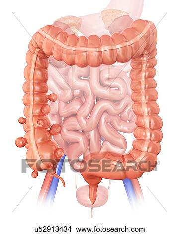 Stock Illustration - Human large intestine showing diverticulitis, computer artwork.. Fotosearch