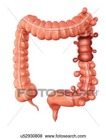 Human large intestine showing diverticulitis, computer artwork. View Large Illustration Stock Illustration - Human large intestine showing diverticulitis, computer artwork.. Fotosearch