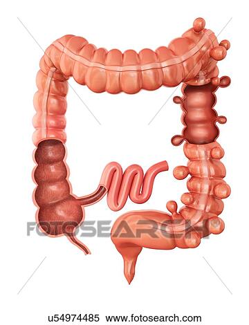 Stock Illustration - Human large intestine showing diverticulitis, computer illustration.. Fotosearch