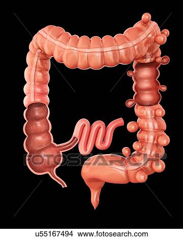 Human large intestine showing diverticulitis, computer artwork. View Large Illustration Stock Illustration - Human large intestine showing diverticulitis, computer artwork.. Fotosearch