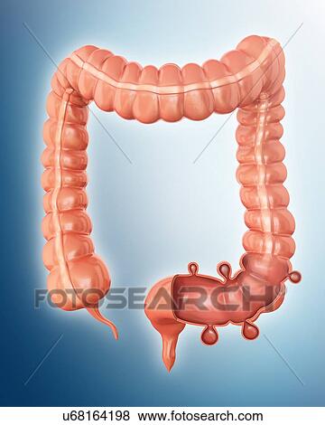 Human large intestine showing diverticulitis, computer illustration. View Large Illustration Stock Illustration - Human large intestine showing diverticulitis, computer illustration.. Fotosearch