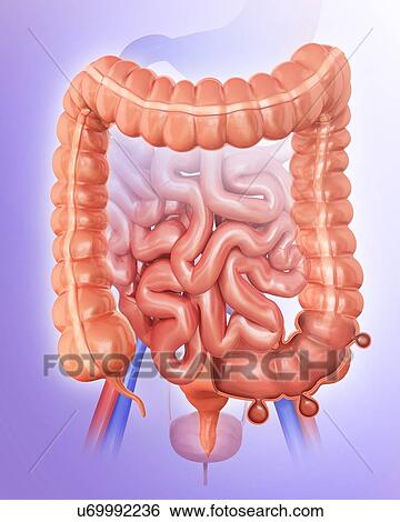 Stock Illustration - Human large intestine showing diverticulitis, computer artwork.. Fotosearch
