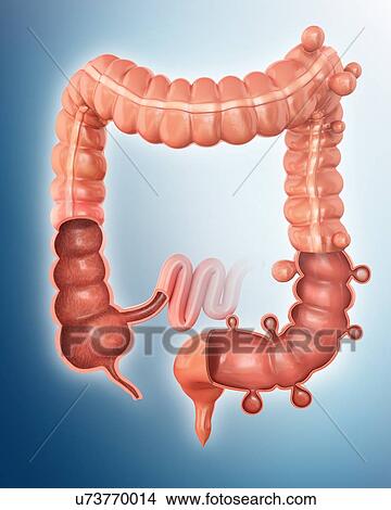 Human large intestine showing diverticulitis, computer artwork. View Large Illustration Stock Illustration - Human large intestine showing diverticulitis, computer artwork.. Fotosearch