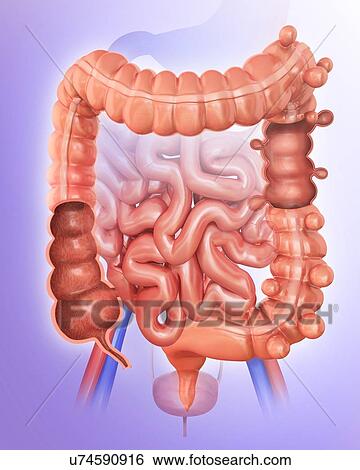 Human large intestine showing diverticulitis, computer illustration. View Large Illustration Stock Illustration - Human large intestine showing diverticulitis, computer illustration.. Fotosearch