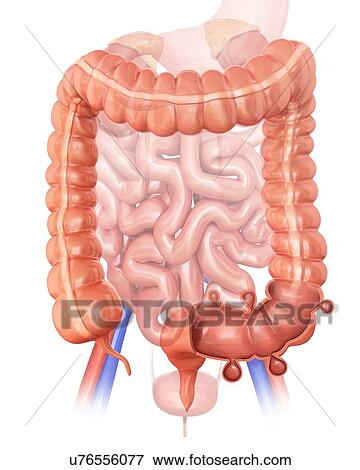 Stock Illustration - Human large intestine showing diverticulitis, computer illustration.. Fotosearch