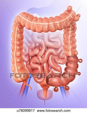 Human large intestine showing diverticulitis, computer illustration. View Large Illustration Stock Illustration - Human large intestine showing diverticulitis, computer illustration.. Fotosearch