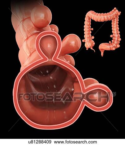 Stock Illustration - Human large intestine showing diverticulitis, computer illustration.. Fotosearch
