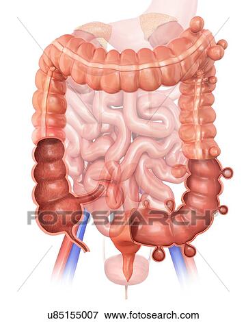 Human large intestine showing diverticulitis, computer illustration. View Large Illustration Stock Illustration - Human large intestine showing diverticulitis, computer illustration.. Fotosearch