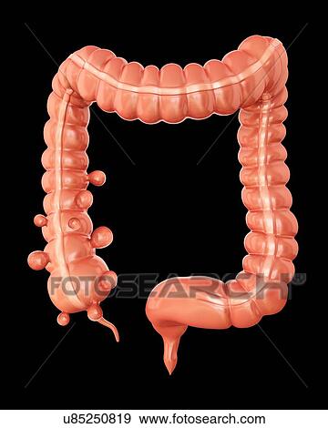 Stock Illustration - Human large intestine showing diverticulitis, computer artwork.. Fotosearch